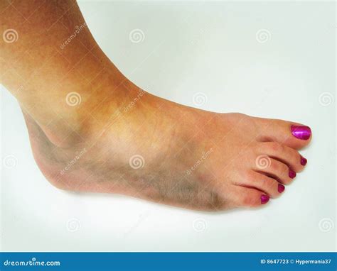 Bruised Ankle Stock Image Image Of Foot Bruise Emergency 8647723
