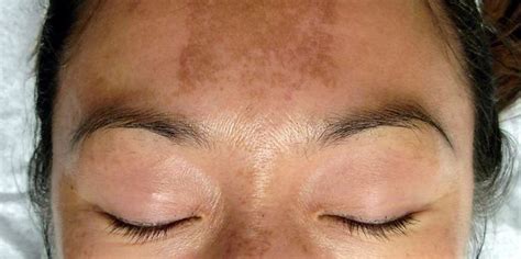 All You Need To Know About Melasma From An Expert Dermatologist