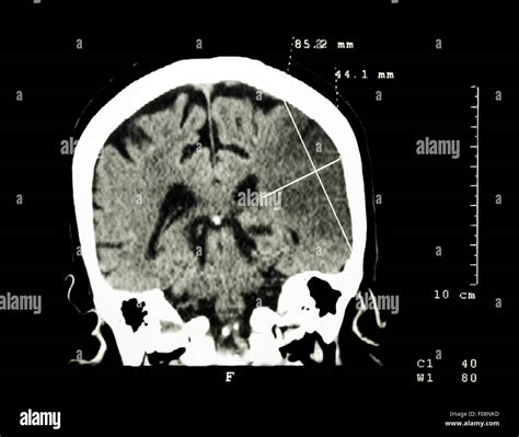 Cerebral Infarction At Left Hemisphere Ischemic Stroke Ct Scan Of