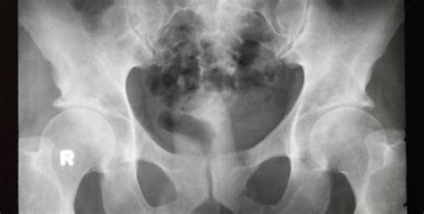 Other conditions, like osteoporosis or arthritis. Ovarian cancer starts elsewhere: study - DAWN.COM