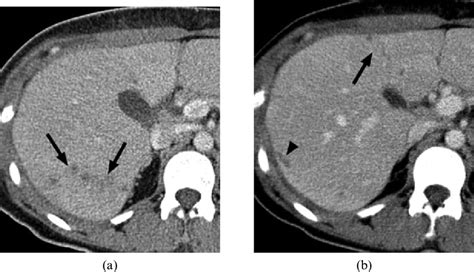 Axial Abdominal Ct Images Of Intrahepatic Lesions Patient 2