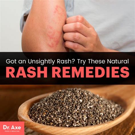 How To Get Rid Of A Rash 6 Natural Rash Remedies Natural Rash Remedies Rashes Remedies Remedies