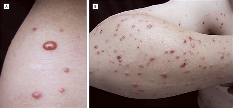 Generalized Cutaneous Papules And Nodules In An Asian Man Dermatology