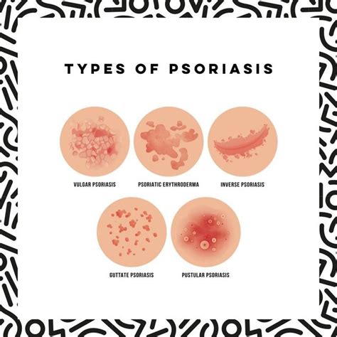Types Of Psoriasis In 2021 Psoriasis Pustular Psoriasis Types Of