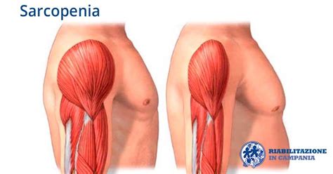 Increase the visibility of your library. Sarcopenia | Riabilitazione in Campania