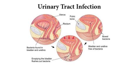 Best Urinary Tract Infections Treatment And Diagnosis India Rg Hospital