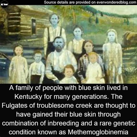 A Sal Of People With Blue Skin Lived In Kentucky For Many Generations
