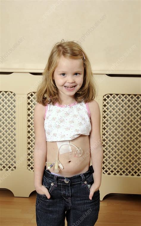 Young Girl With Gastric Feeding Tube Stock Image C0038856