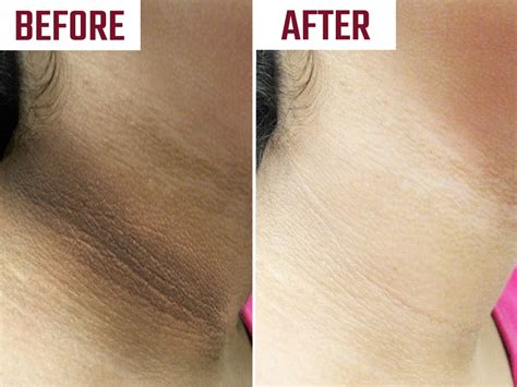 How To Remove Tanning From Neck चेहरा गोरा अन् मान काळपटपण पडलीये