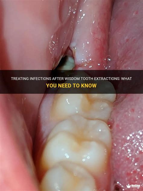 Treating Infections After Wisdom Tooth Extractions What You Need To Know Medshun
