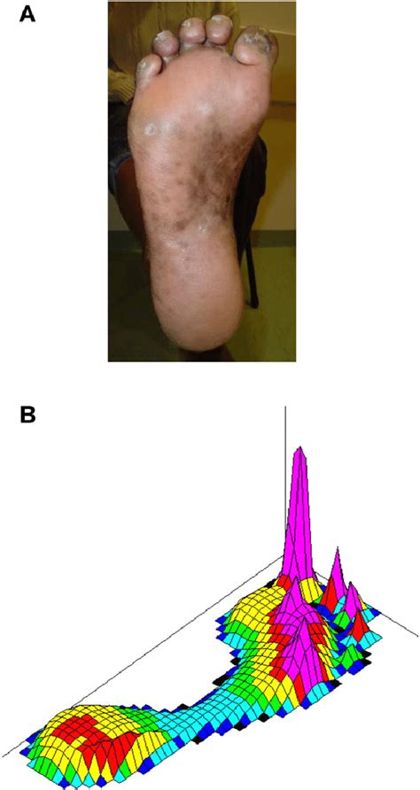 A Illustrations Of A Neuropathic Foot Of A Person Affected By Leprosy