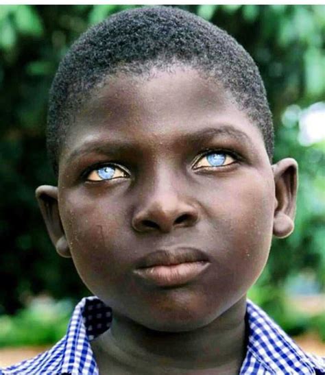 Ocular Albinism Medizzy