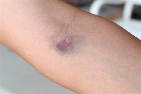 2200 Arm Bruises Pictures Stock Photos Pictures And Royalty Free