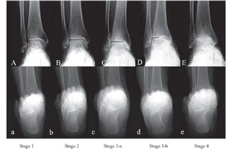 Figure 4 From The Use Of Osteotomies In The Treatment Of Asymmetric