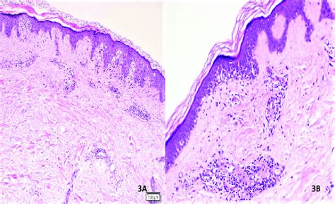 Maculopapular Eruptions In The Histopathological Examination Of The