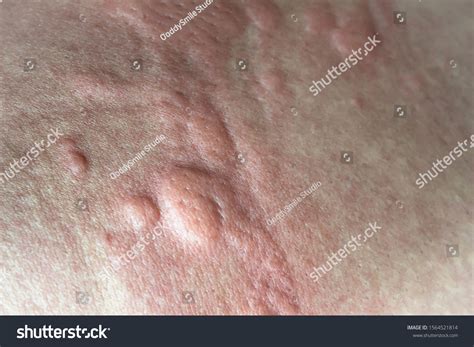 Urticaria On Skin Rashes Which Urticaria Stock Photo 1564521814
