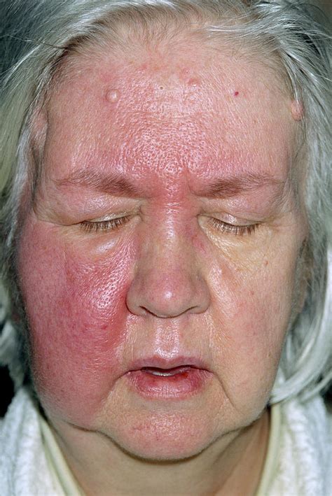 Cellulitis Infection Photograph By Dr P Marazziscience Photo Library