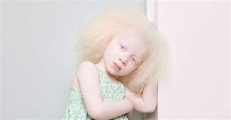 Pictured People Living With Albinism Reveal The Human Side Behind