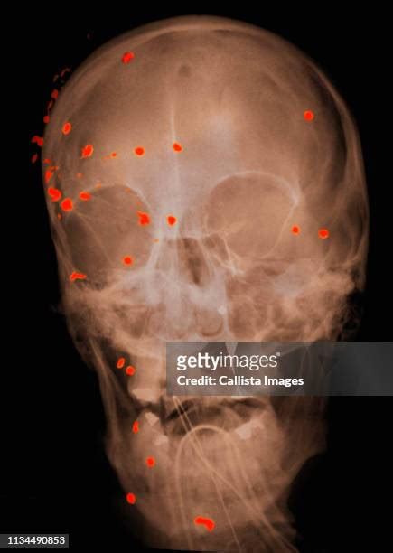 Of Gunshot Wounds To The Head Photos And Premium High Res Pictures