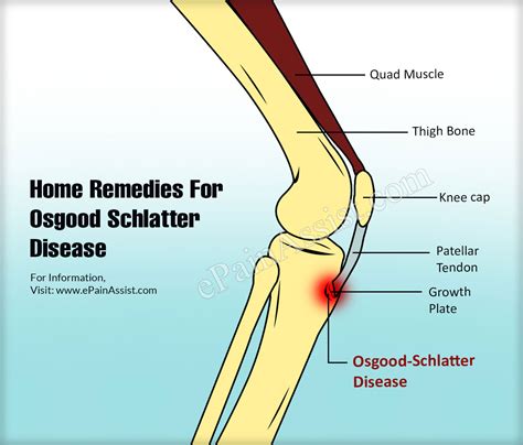 Home Remedies For Osgood Schlatter Disease