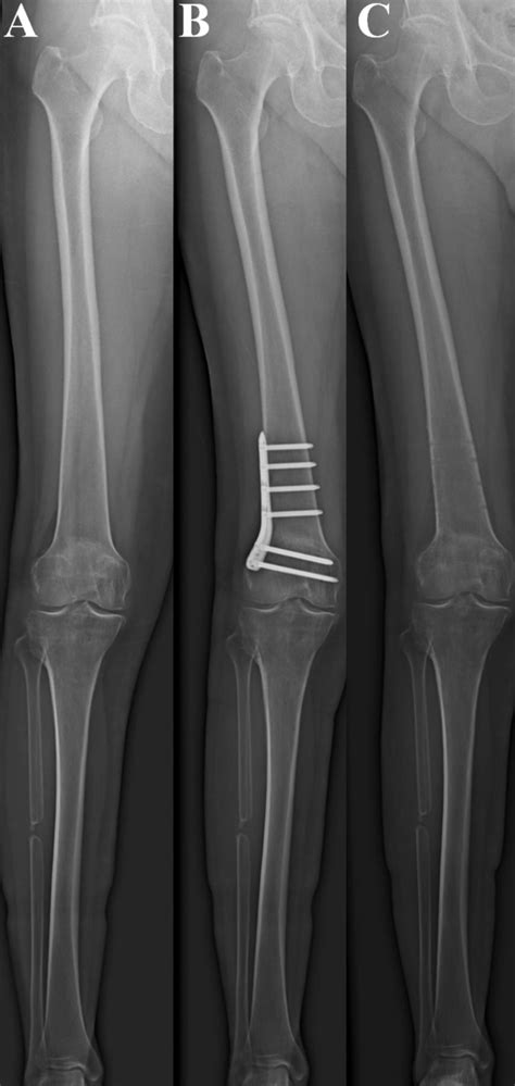 Additional Distal Femoral Osteotomy For Insufficient Correction After