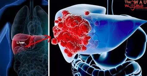 Know The 6 Signs Of Liver Cancer Before Its Too Late