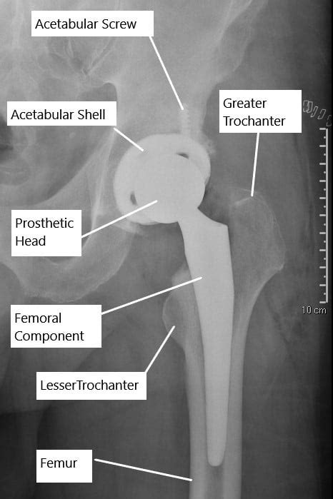 Cemented Vs Uncemented Hip Replacement Aldecoaroegner 99