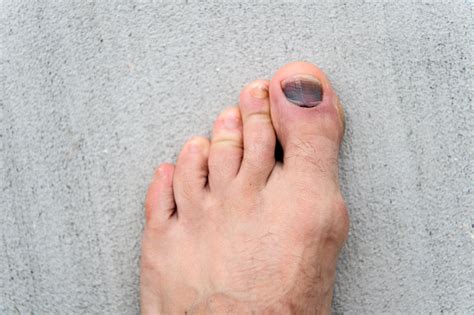 Nail Hematoma Take Care Of Your Feet Pedicure And Podiatry Treatment Of