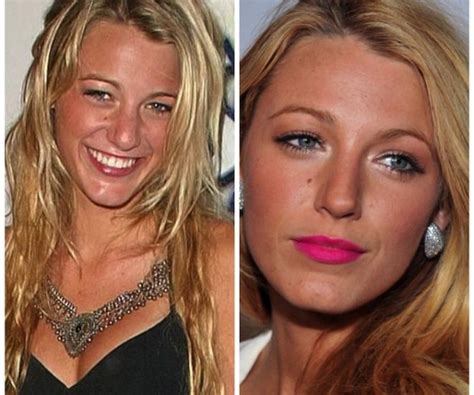 Blake Lively Nose Job Photos Before After Nose Job Blake Lively Blake Lively Nose