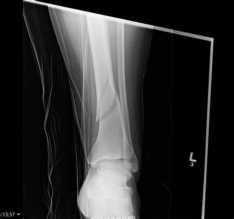 Cureus Fracture Nonunions And Delayed Unions Treated With Low