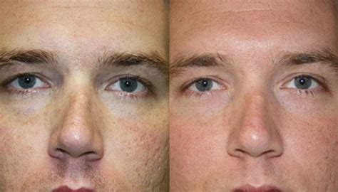 Skin Laser Skin Resurfacing Laser Treatment Healthy Tips