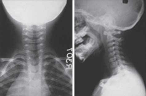 Cervical Spine Radiographs Shows Calcified Disc At C6 C Open I