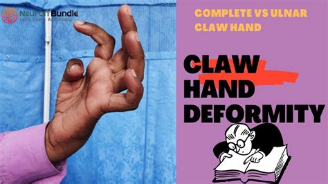 Claw Hand True Claw Hand And Causes Ulnarclawhand Median Nerve
