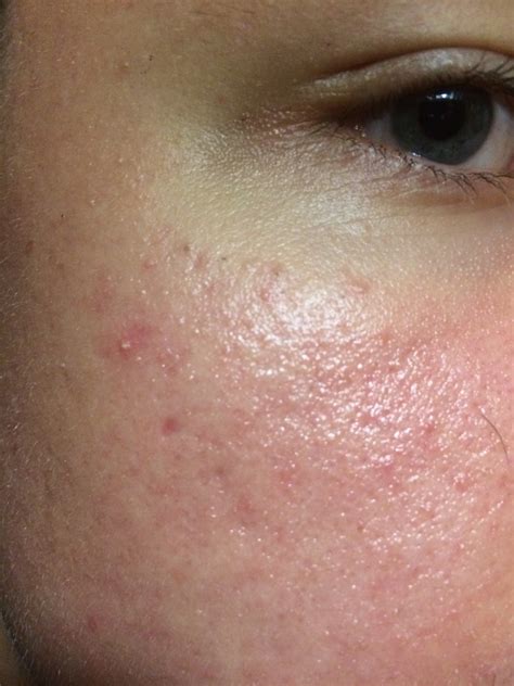 Skin Concerns My Face Feels Tight And Is Red With Very Tiny Little