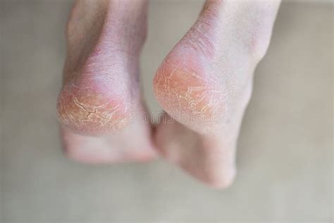 Close Up Cracked Heels Health Problems With Skin On Feet Stock Image