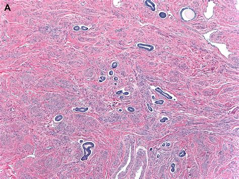 Atypical Endometrial Hyperplasia And Well Differentiated Endometrioid Adenocarcinoma Of The