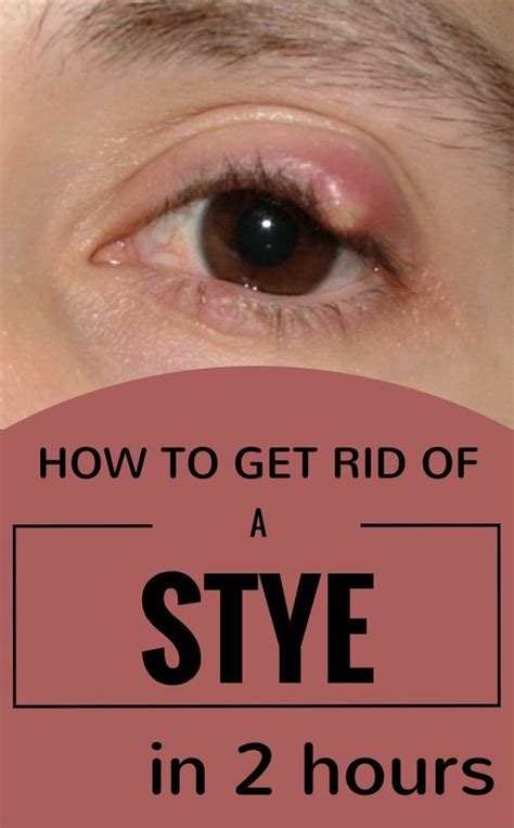 What To Do For A Stye On Upper Eyelid