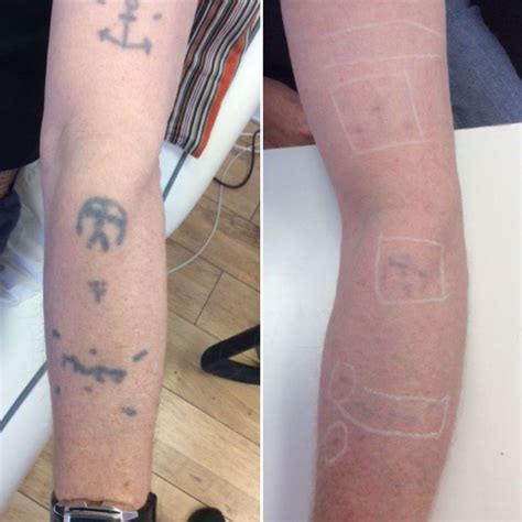 After 6 Treatments With The Picosure Laser Laser Tattoo Laser Tattoo