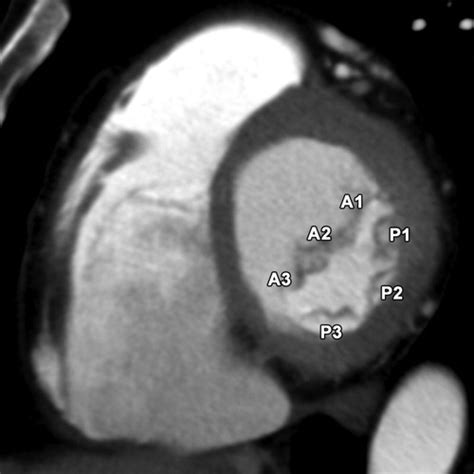 Ct And Mr Imaging Of The Mitral Valve Radiologic Pathologic