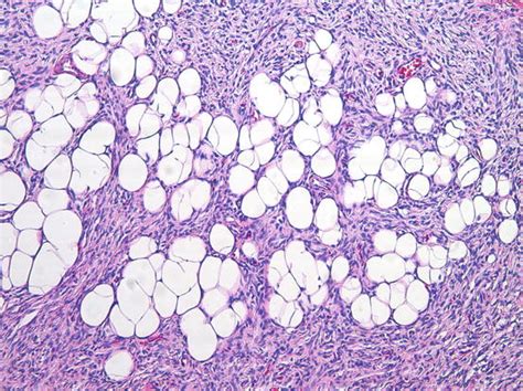 Dermatofibrosarcoma Protuberans Musculoskeletal Key