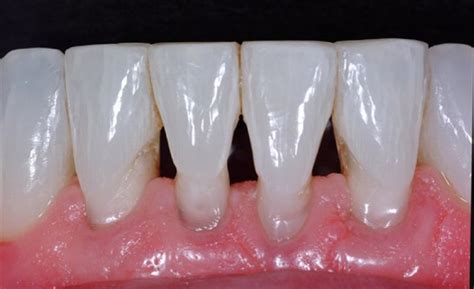 Pictures Of Black Tartar On Teeth Teethwalls