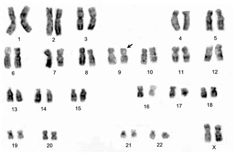Simple Structural Chromosomal Abnormalities In Advanced Stage Of