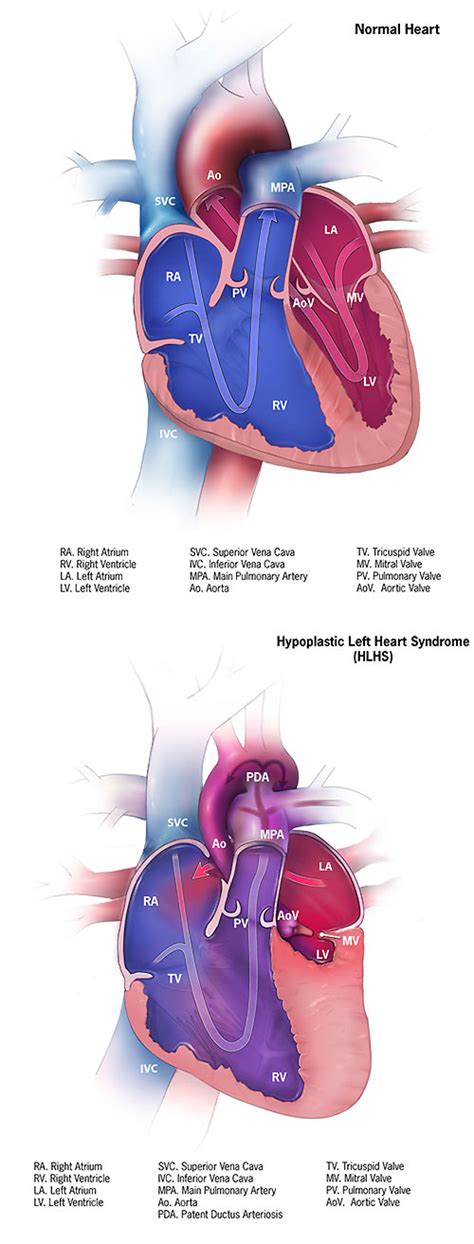 Facts About Hypoplastic Left Heart Syndrome Congenital Heart Defects