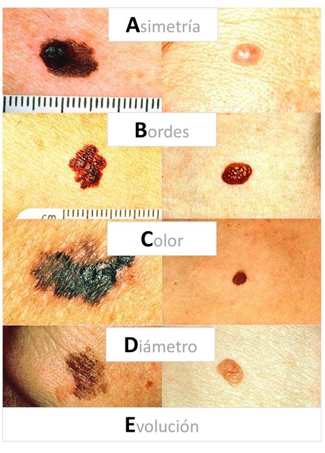 Melanoma Skin Cancer Abcde