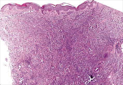 Multiple Violaceous Nodules In A Neonate—quiz Case Neonatology Jama