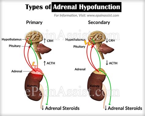 What Is Adrenal Hypofunction And How Is It Treated