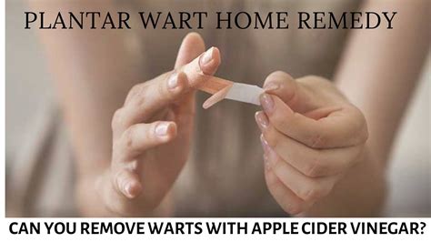 Can You Remove Warts With Apple Cider Vinegar Plantar Wart Home