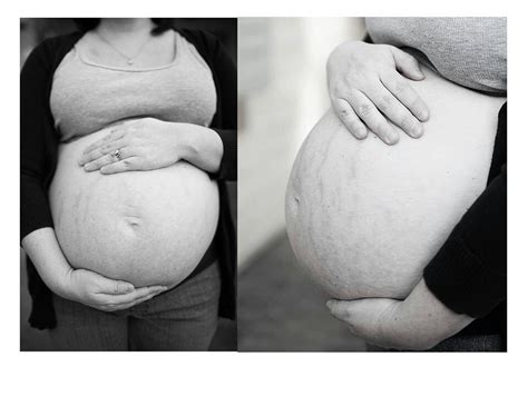 Stretch Marks ♡ Stretch Marks Pregnant Women Projects To Try