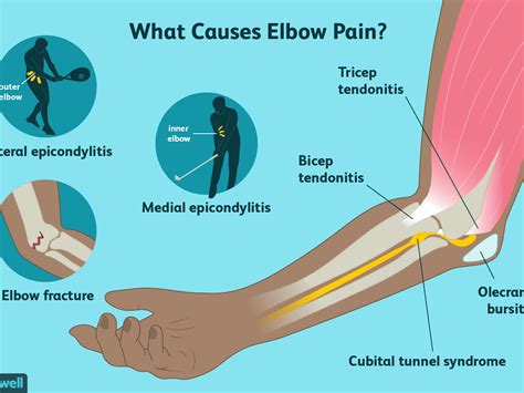 How To Cure Elbow Pain Shopfear0