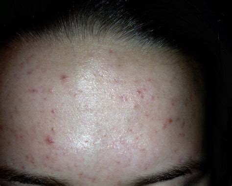 Forehead Acne 19 Girl General Acne Discussion Community